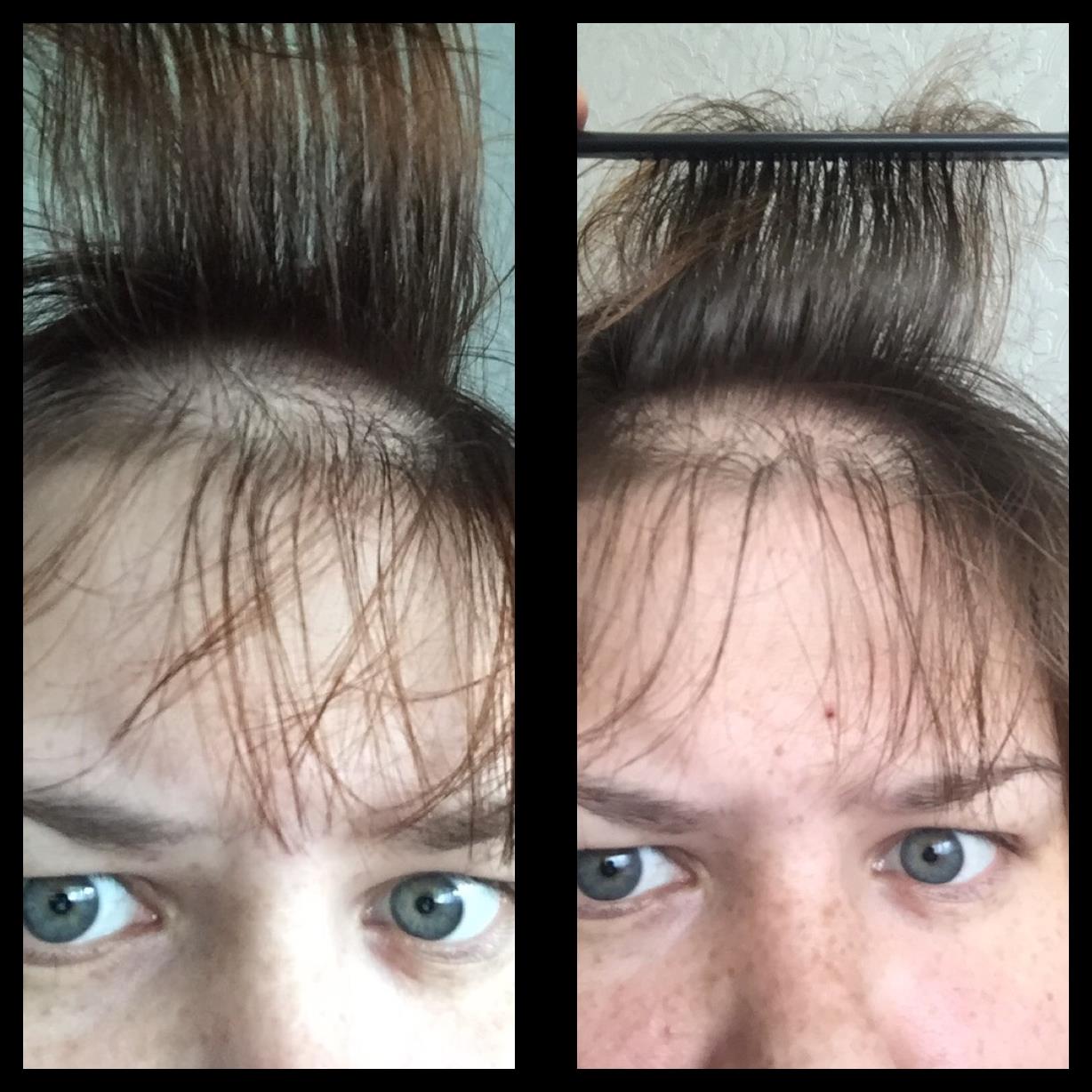 Волосы перестали выпадать после. Выпадение волос до и после. Отросшие волосы после выпадения.