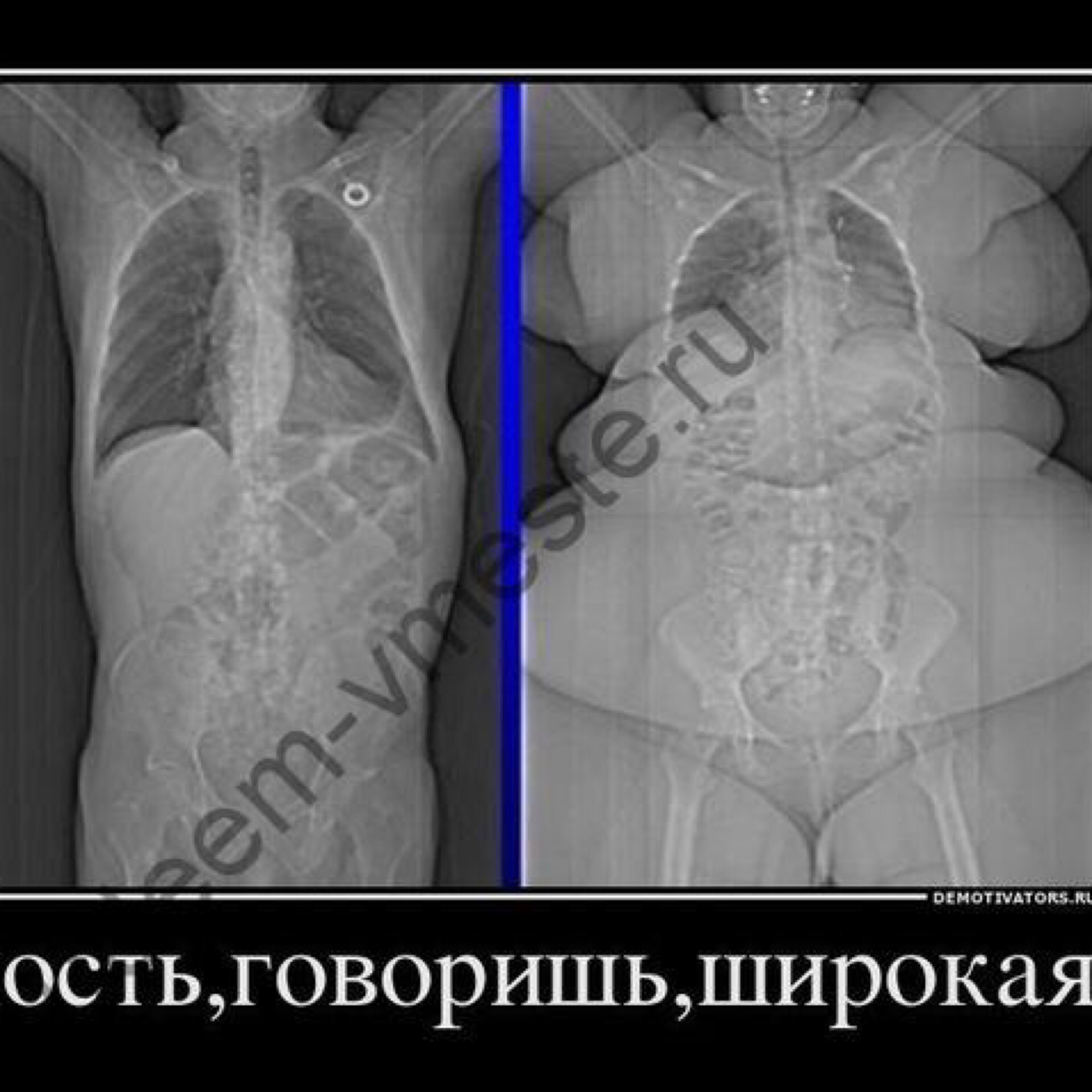 Скелет Толстого человека рентген