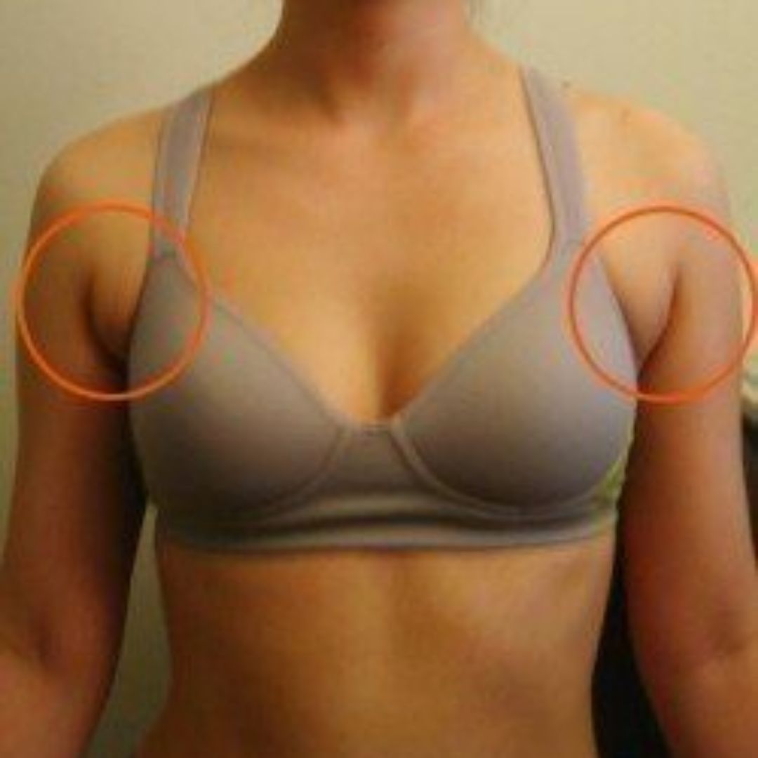 уплотнение в груди у женщин операция фото 69